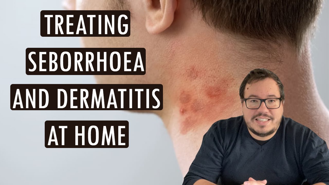 😉Treating seborrhoea and dermatitis at home: 5+1 proven tips to relieve symptoms. - hillvitalusa.com