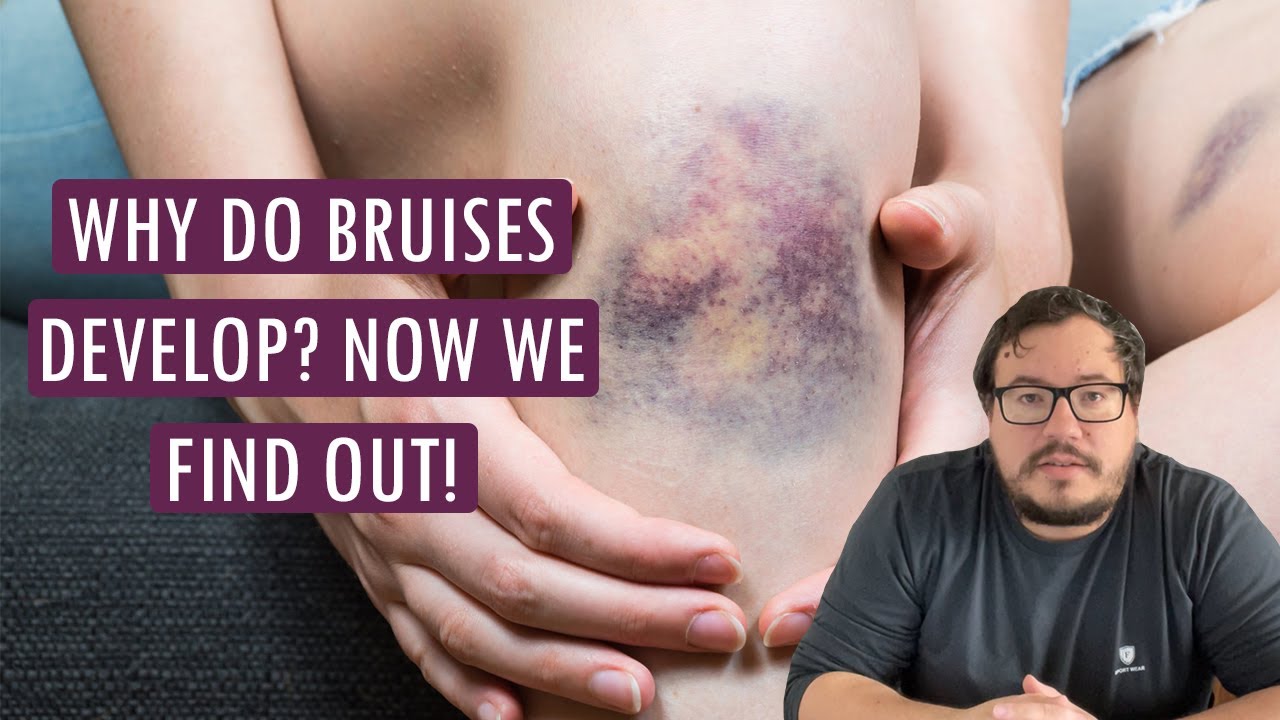 Blue, green, purple spots on the skin: why bruising develops?🤔 - hillvitalusa.com