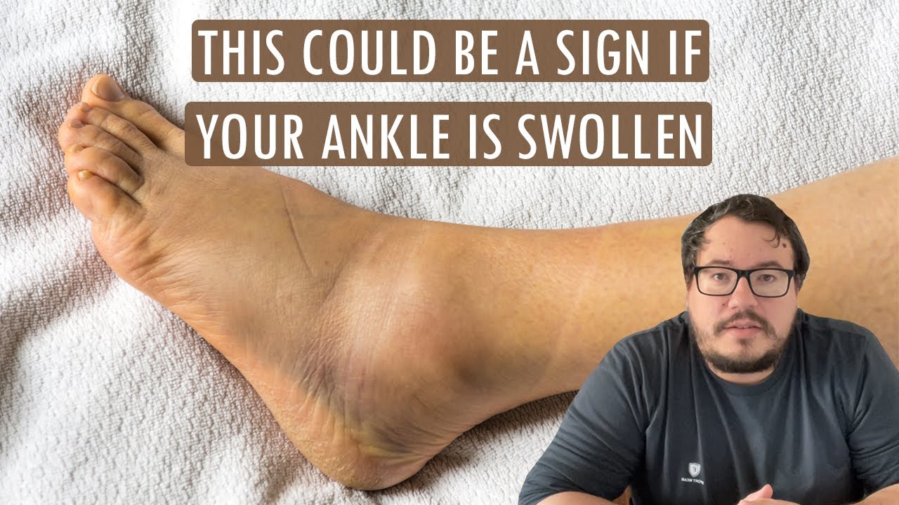 😮This could be a sign if your ankle is swollen! - hillvitalusa.com