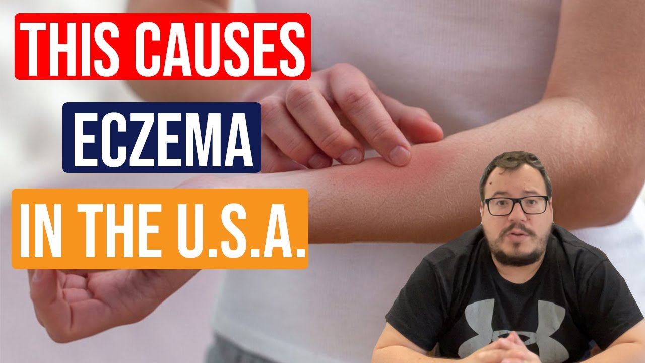 ☝️Eczema in the U.S. - hillvitalusa.com