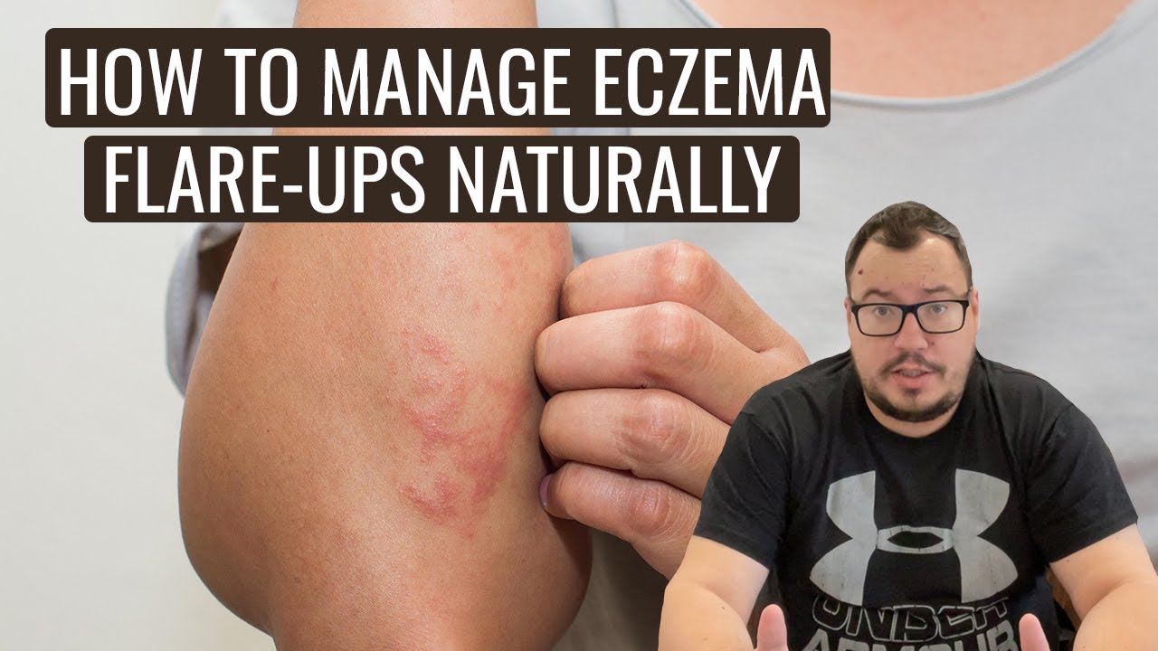 🤔How to Manage Eczema Flare-Ups Naturally! - hillvitalusa.com