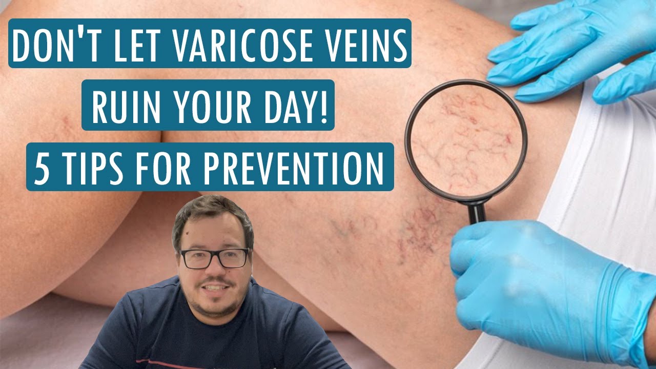 ☝️Don't let varicose veins ruin your day! 5 tips for prevention! - hillvitalusa.com