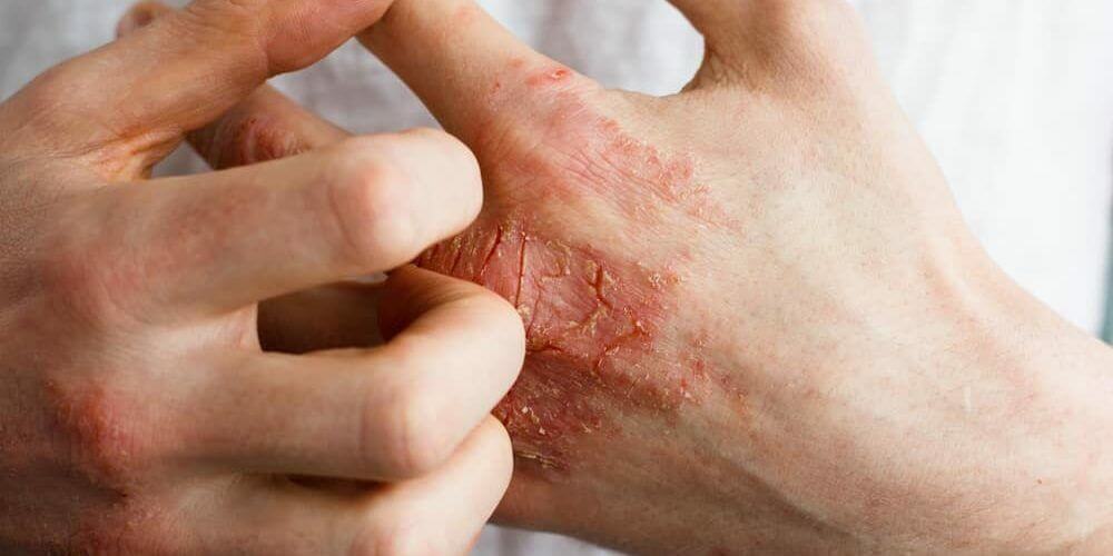 Shocking eczema pictures and remedies