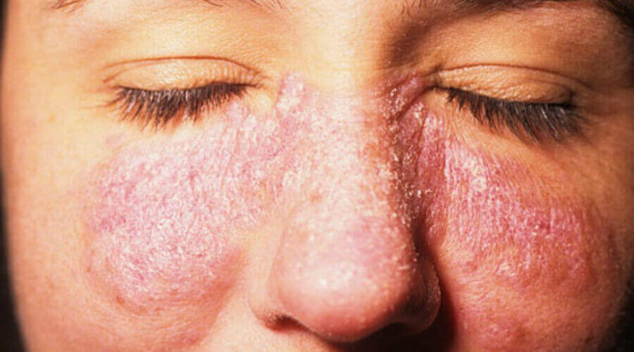 Eczema on the face illustrated with pictures