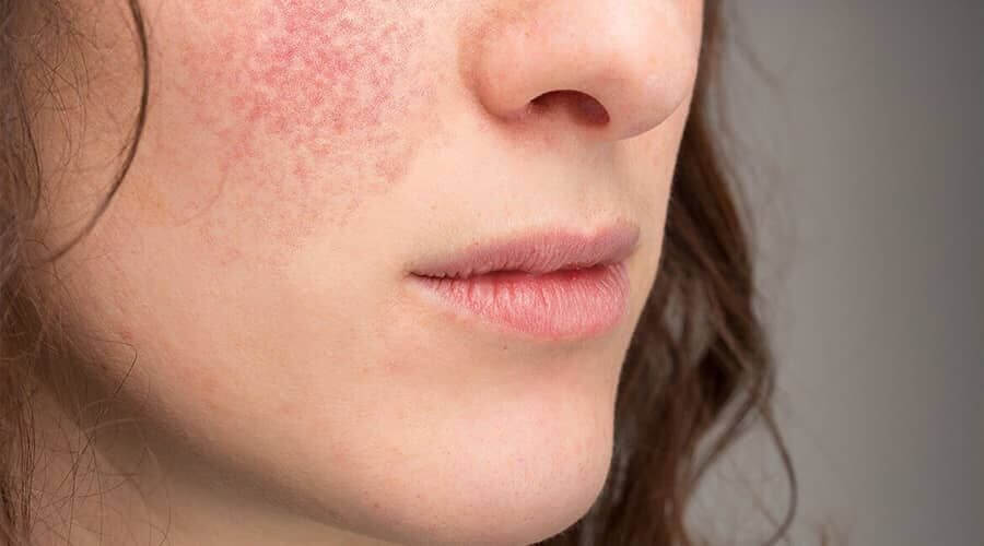 Eczema on the face illustrated with pictures