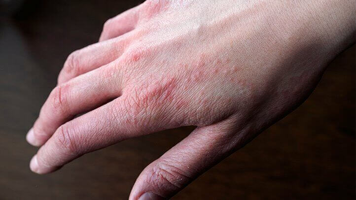 Eczema on the hand illustrated with pictures