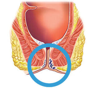 External haemorrhoids