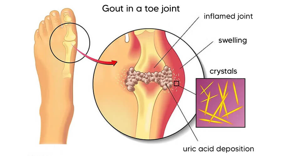 Gout in a toe joint.