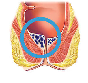 Internal haemorrhoids