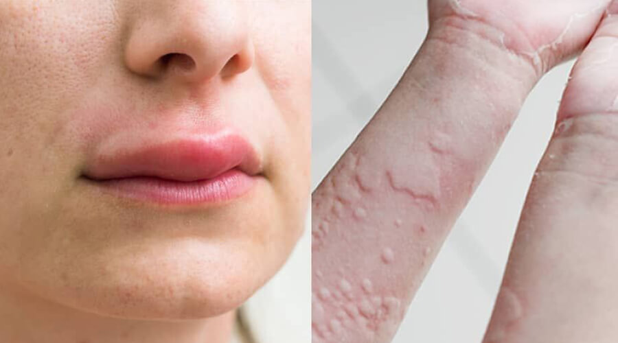 Pictures of allergy symptoms on the skin