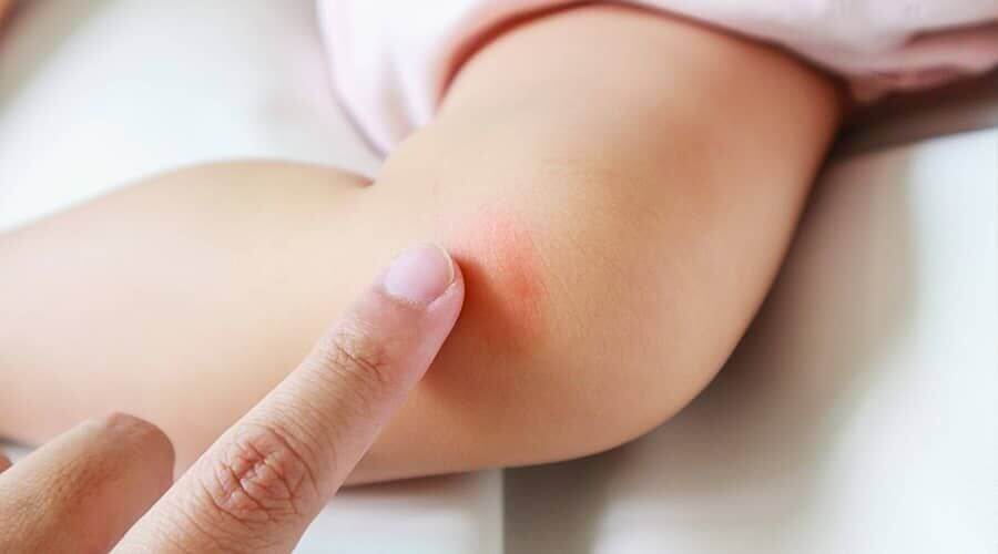 Shocking eczema pictures and remedies