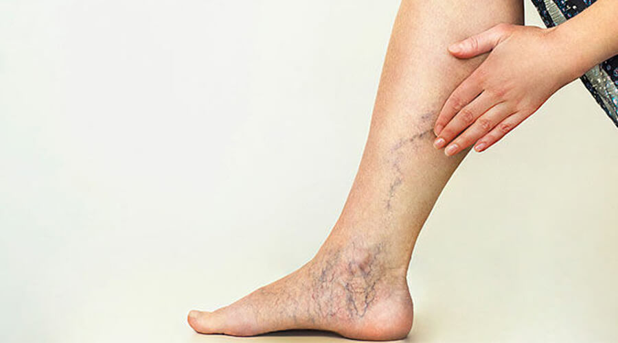 Varicose veins