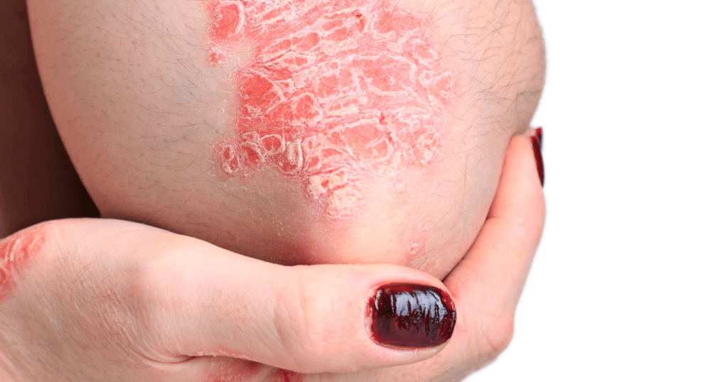 Types of eczema illustrated with pictures