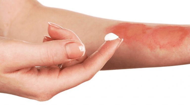 A lady is treating mild burns with ointment