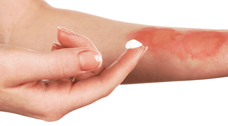 Mild burns can be treated with ointment!