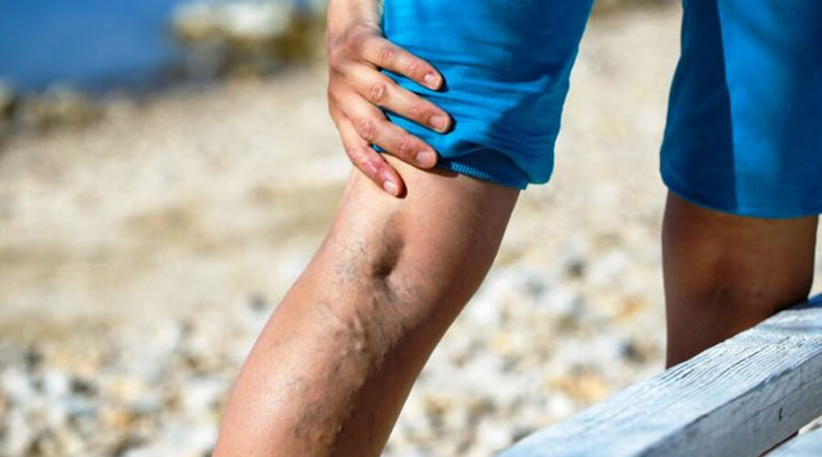 The main cause of itchy varicose veins