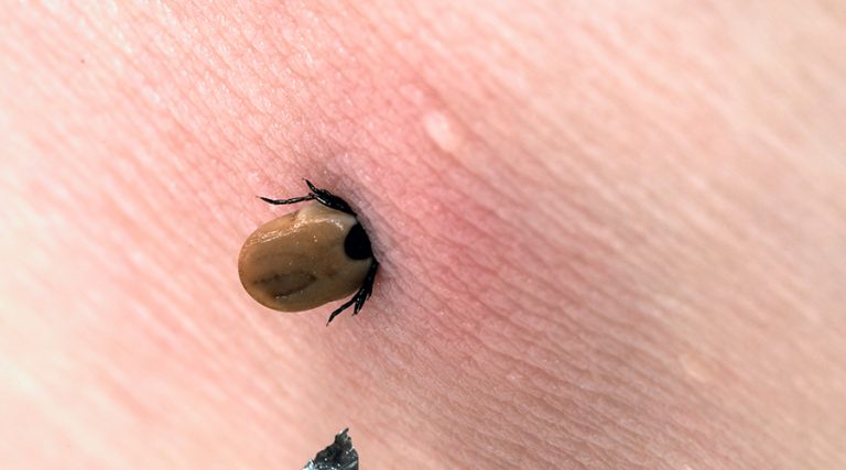 close up image of a tick attached to human skin
