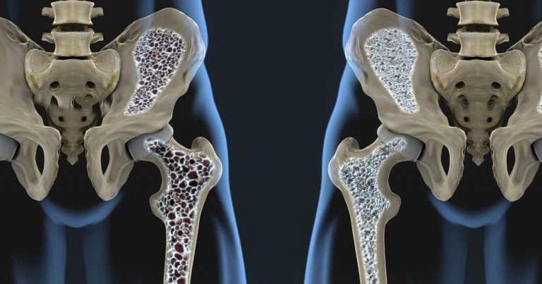 comparison of healthy and osteoporotic hip bone, showing bone density difference