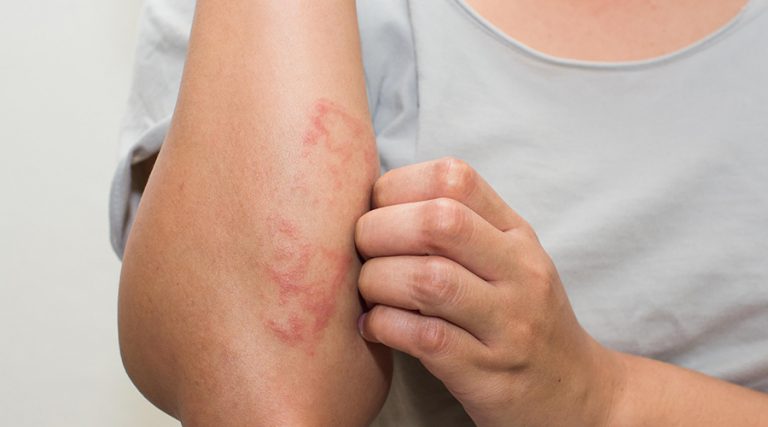 person scratching his arms suffering from eczema