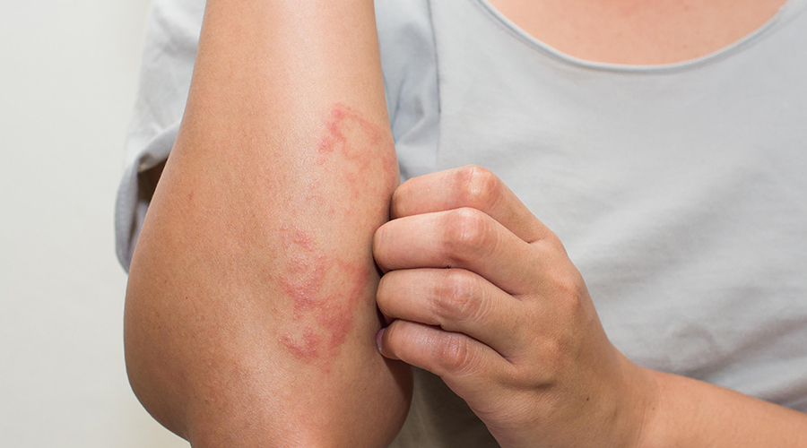 These are the most common causes of eczema!