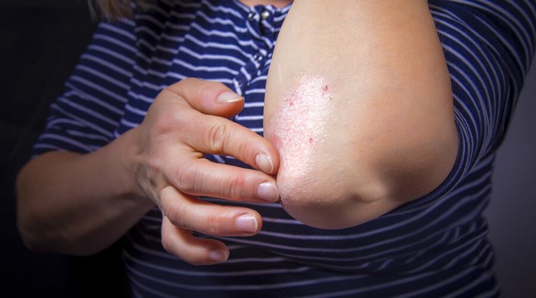 women touching her elbow suffering from psoriasis problem