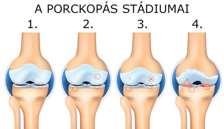 An illustration showing the four stages of cartilage wear in the knee joint, labeled numerically from 1 to 4, depicting the progression from healthy cartilage to severe degeneration.