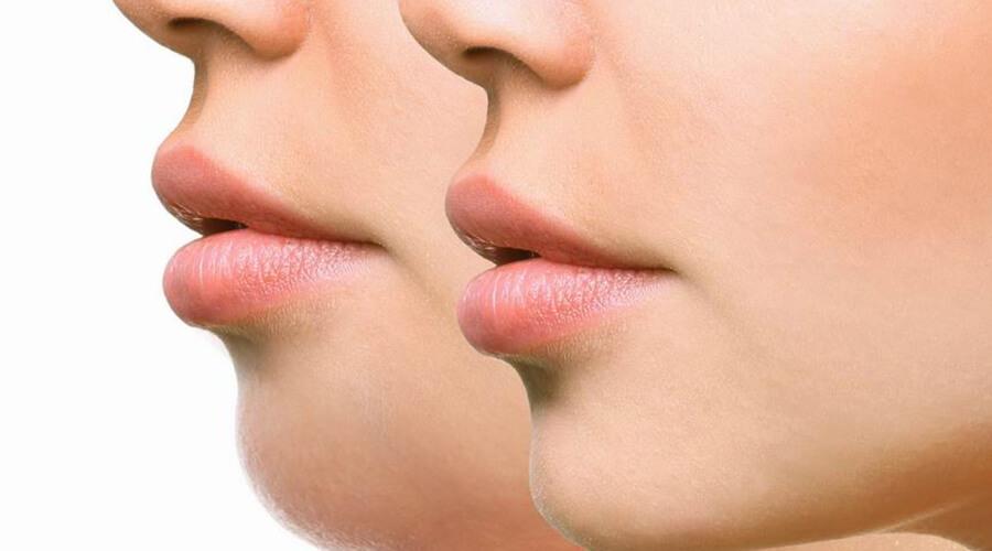 With these simple home remedies, it's easy to get rid of unsightly and annoying double chins.