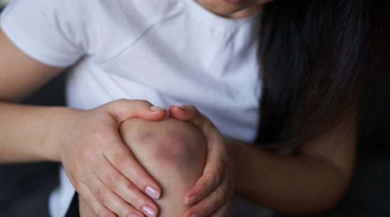 lady having bruise on her knee while placing her hands on knee