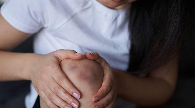 women with bruises holding her knee