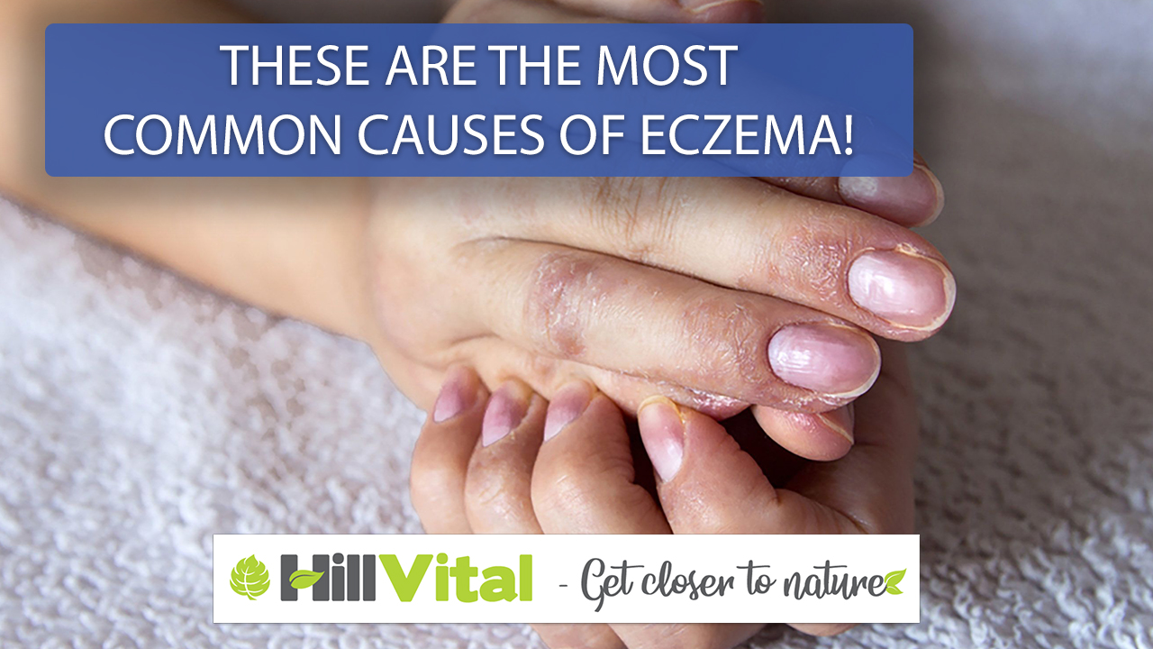 These are the most common causes of eczema!