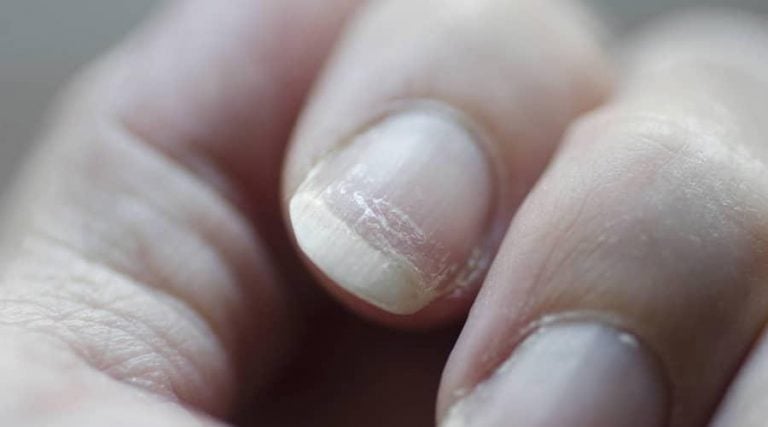 close up of a person's nail with psoriasis