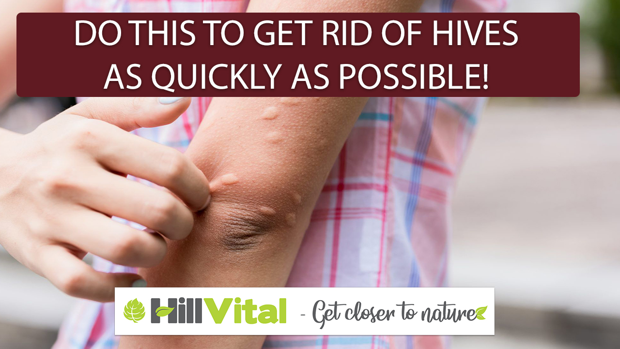 Do this to get rid of hives as quickly as possible!