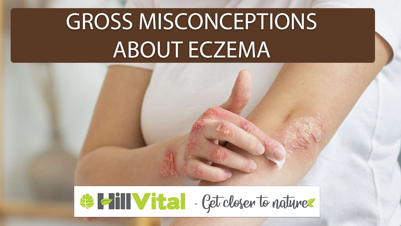 Gross misconceptions about eczema