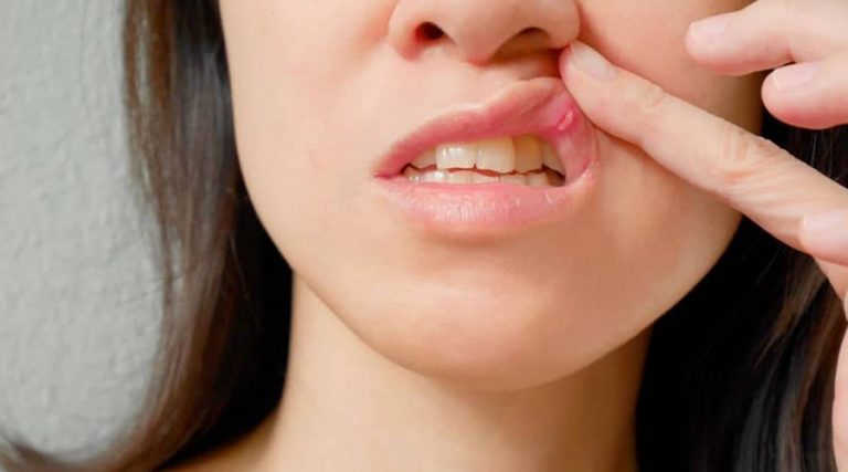 women touching her lips with herpes