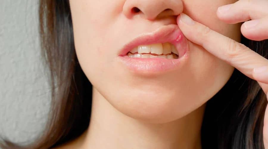 Here’s what you need to know about herpes