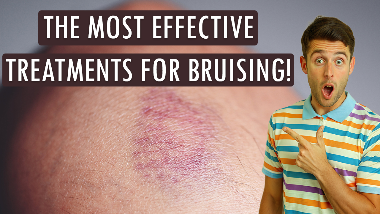 The most effective treatments for bruising!