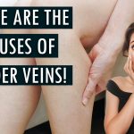 These are the causes of the development of spider veins!