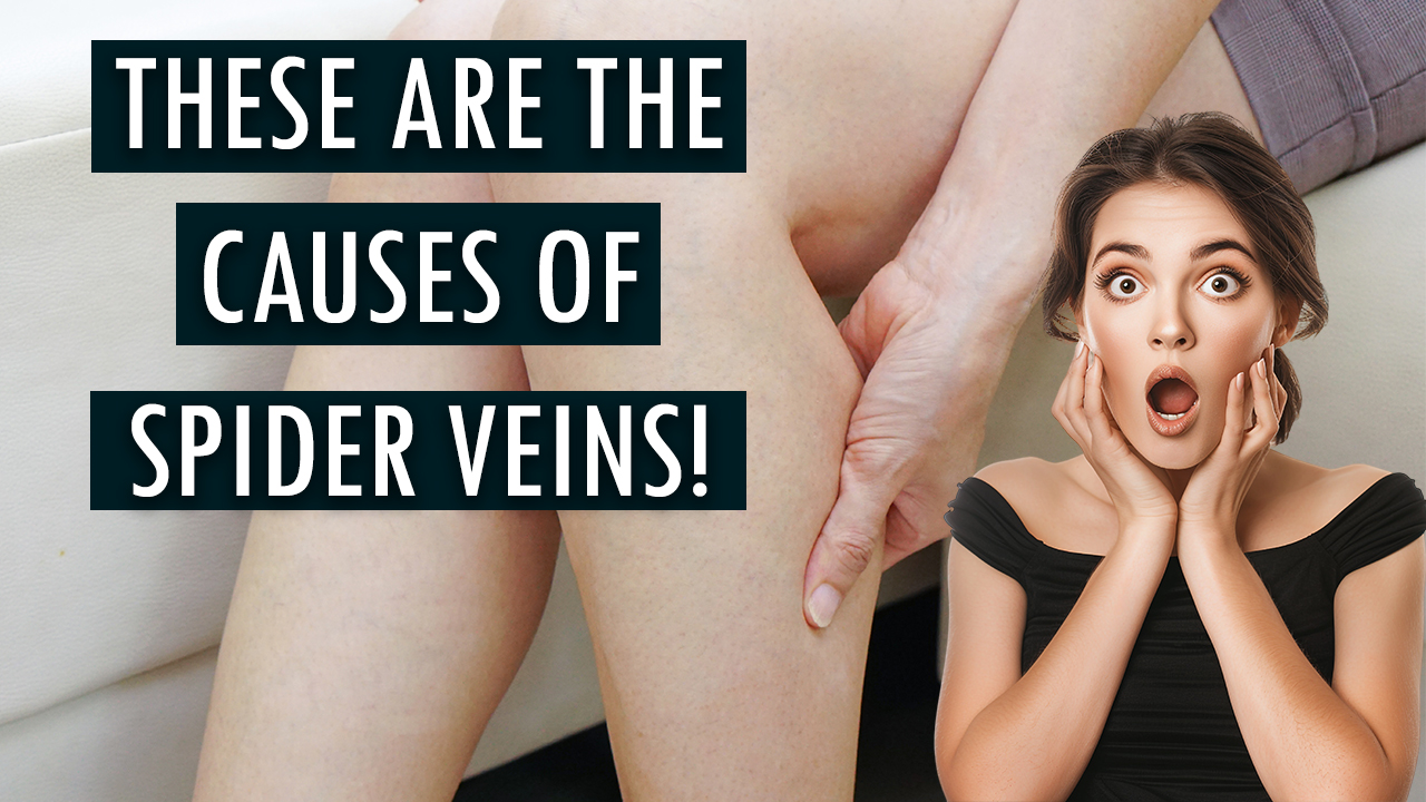 These are the causes of the development of spider veins!