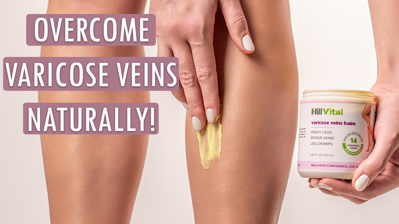 Overcome varicose veins naturally!