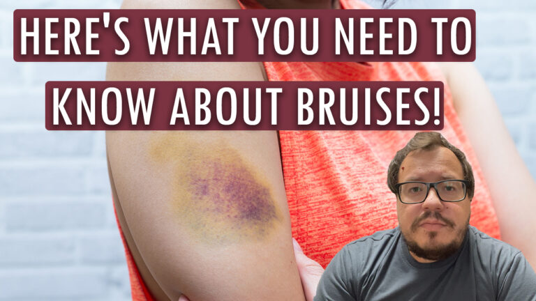 thumbnail of video showing Here's what you need to know about bruises!