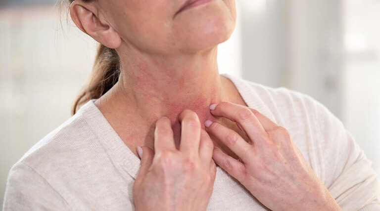 How to get rid of eczema