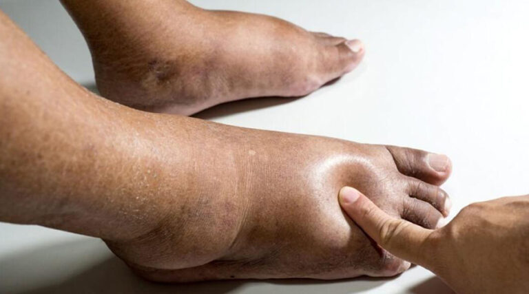 STOP oedema! Natural solutions against water retention