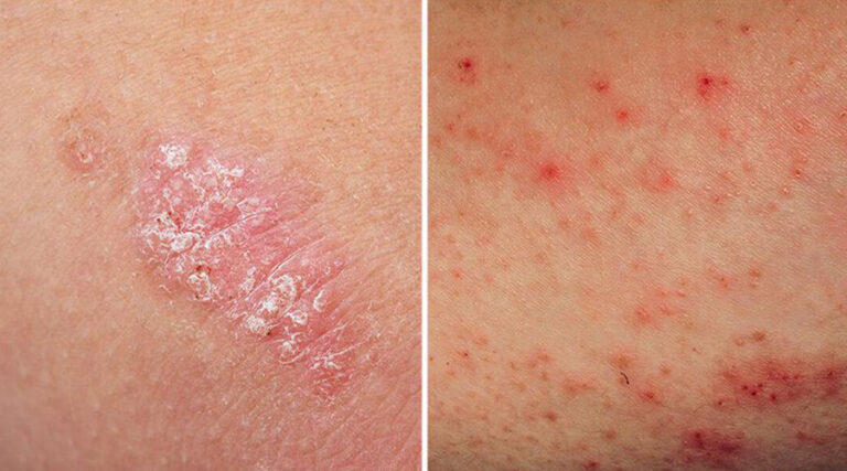 Psoriasis, eczema, dermatitis? 5 instant tips to relieve itching!