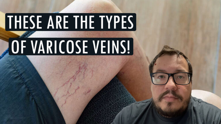 Here's what you need to know there are so many species of varicose veins