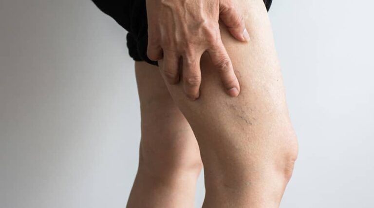 Signs of Blood Clot