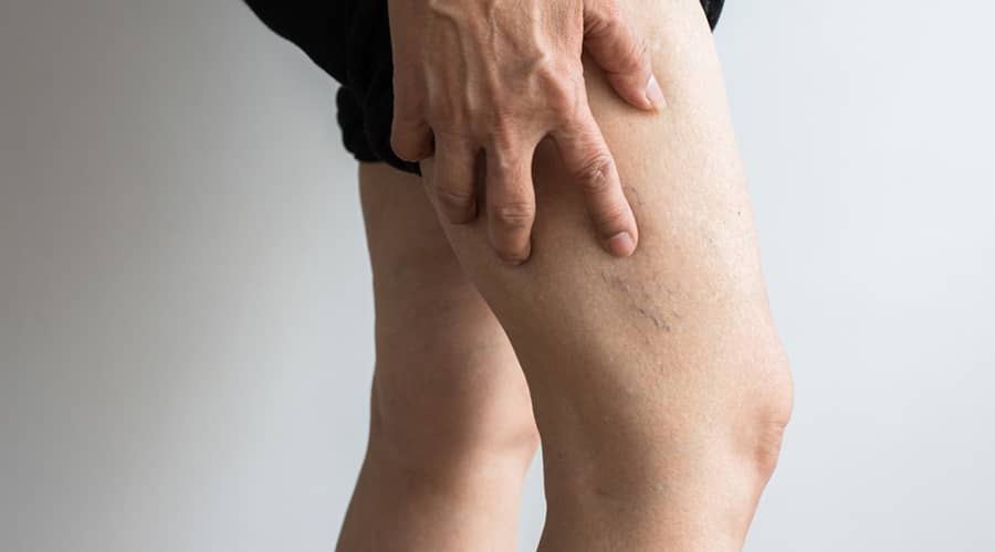 Signs of Blood Clot