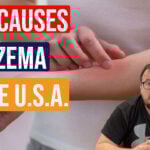Eczema in the U.S.