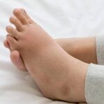 Summer Foot Swelling