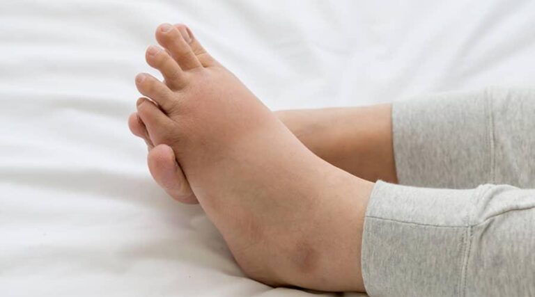 Summer Foot Swelling