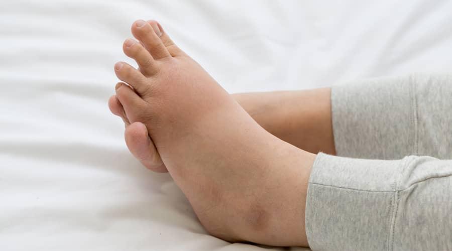 Summer Foot Swelling Is More Than Just a Cosmetic Problem – When Should You See a Doctor? 1 Summer Foot Swelling